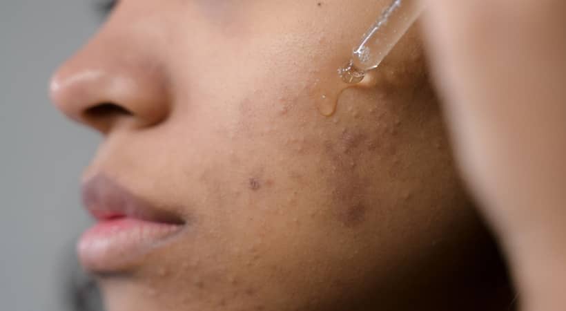 Importancia de tratar el acné en adolescentes